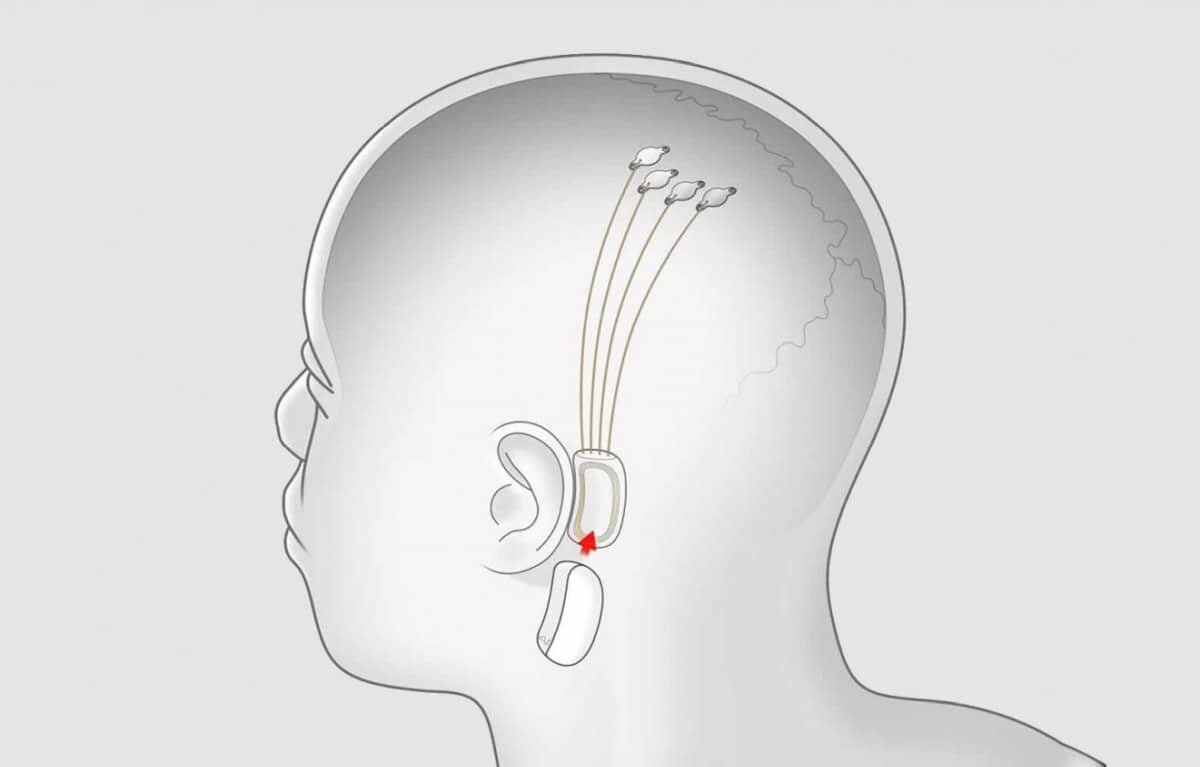 Чип Neuralink Чип Neuralink